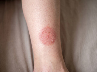 Fototapeta premium Lower leg with nummular eczema showing round coin-shaped red scaly patch on shin, discoid dermatitis skin condition medical concept