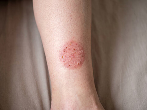 Lower leg with nummular eczema showing round coin-shaped red scaly patch on shin, discoid dermatitis skin condition medical concept