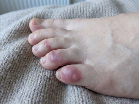 Toes with chilblains pernio showing purplish red swollen patches from cold exposure, winter skin condition dermatology medical concept