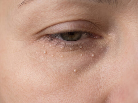Close-up of under eye skin with milia showing small white pinpoint bumps, common benign skin condition dermatology concept
