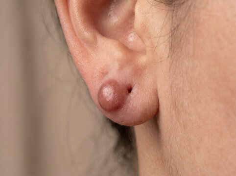 Earlobe with keloid scar showing raised smooth overgrown scar tissue from piercing, abnormal scarring dermatology medical concept