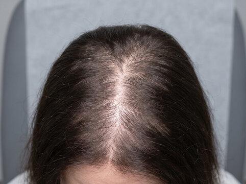 Scalp crown showing diffuse hair thinning from telogen effluvium, temporary hair loss condition trichology medical concept