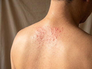 Naklejka premium Back skin with miliaria prickly heat rash showing tiny red pinpoint bumps, heat-induced skin condition dermatology summer concept