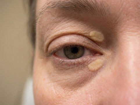 Eyelid skin with xanthelasma showing yellow flat cholesterol deposit patches near eye, lipid skin condition dermatology medical concept