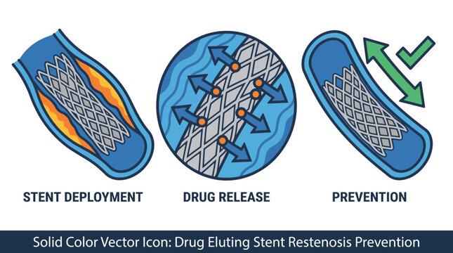 Drug Eluting Stent Restenosis Prevention Drug Release Mechanism