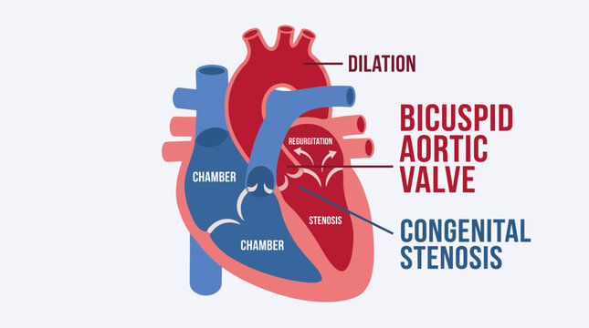 Bicuspid Aortic Valve Congenital Stenosis Regurgitation Dilation