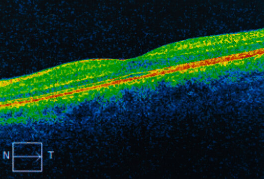 A cross-sectional view of the human retina, known as an Optical Coherence Tomography (OCT) scan