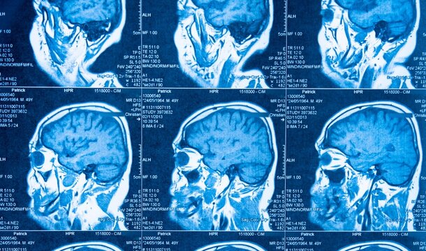 Blue MRI scans show human brain cross-sections. No emotions visible as no people are depicted. Medical, research, or educational use advised. Suitable for neuroscience, diagnostics