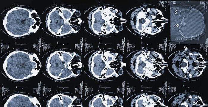 Medical scan shows detailed brain cross-sections. Multiple axial views reveal cerebral structure and anatomy. Images display normal and varied brain tissue density