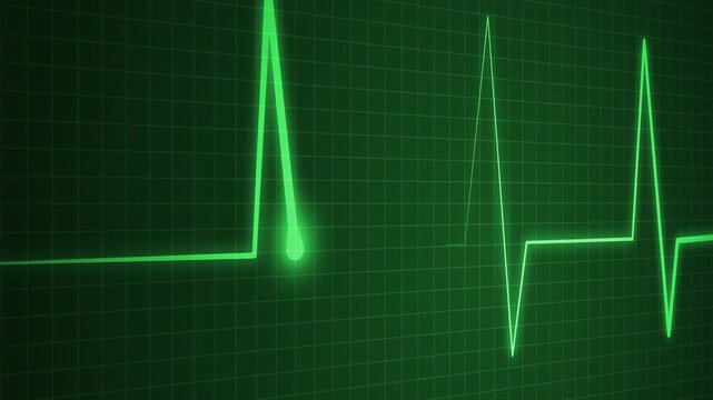 Ecg heart rhythm line on graph paper showing pulse spikes and flat line animation