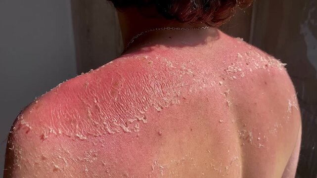 Burnt red skin. The skin flakes off a lot after the sun. The tanned back and shoulders of a young guy. The concept of tanning. 4k