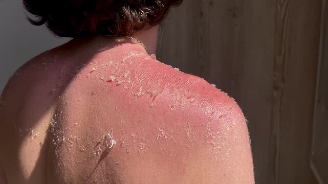 Burnt red skin. The skin flakes off a lot after the sun. The tanned back and shoulders of a young guy. The concept of tanning. 4k