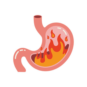 Anatomical of a human stomach with internal fire representing heartburn, acid reflux, and severe gastric pain, flat