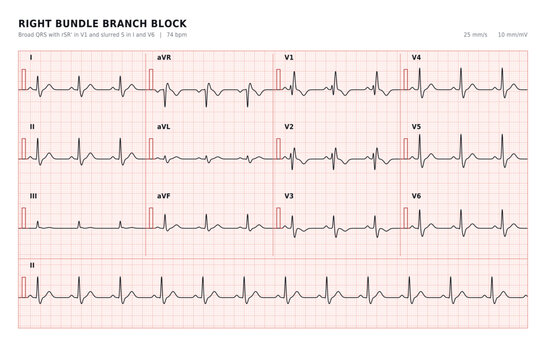 Right Bundle Branch Block 12-Lead ECG with RSR Pattern in Lead V1