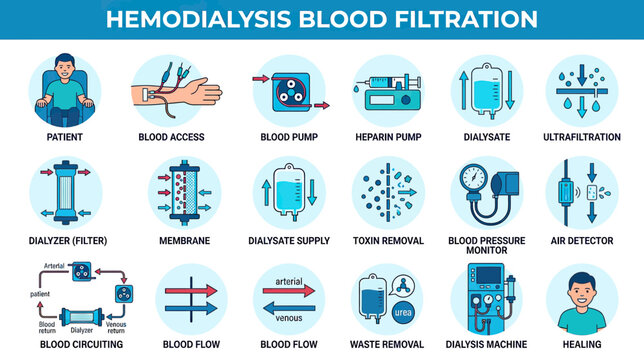 Medical Infographic: Hemodialysis Blood Filtration Process