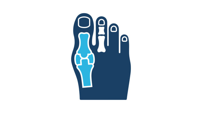 Hallux Valgus Icon: Bunion Deformity of the Big Toe Joint