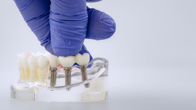 Modern implantology concept header: Doctor holding ceramic crowns over titanium screws in clear acrylic lower jawbone model.