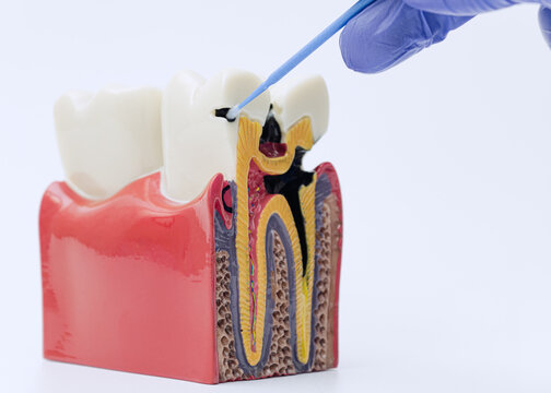 Caries Treatment Demonstration on Cross Section Tooth Anatomy Model