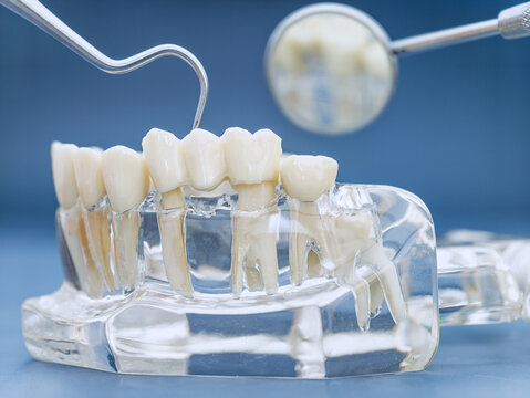 Dentist examining a dental bridge and an impacted wisdom tooth on a transparent teaching model with a probe and mirror. Prosthodontics and surgery concept.