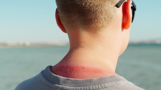 Painful sunburn on the back and neck of a teenage child. Close-up of reddened and flaky skin.