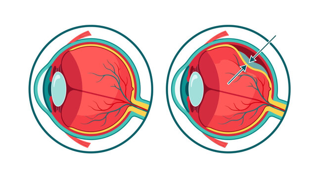 Human Eye Anatomy Comparison cross-section diagram showing normal retina versus retinal detachment with arrows ideal for ophthalmology education and medical presentations.