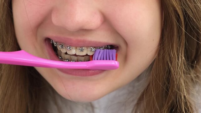 Close up teen girl with braces brushing her teeth with pink toothbrush. Orthodontic treatment, dental and oral care concept