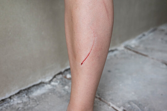 Woman's leg with a bleeding cut after a workplace accident at a construction site. Concept of occupational injury