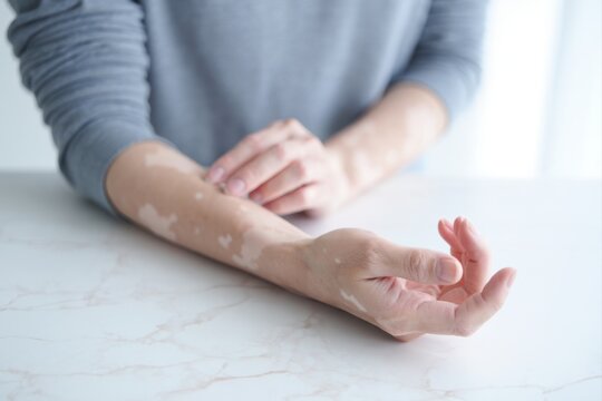 Person showing arm and hand with vitiligo skin condition on white table.