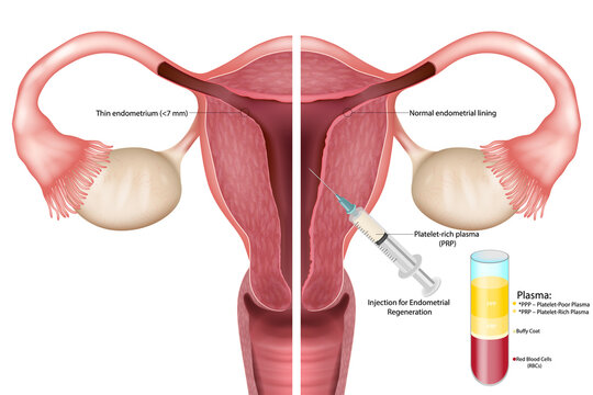 Medical  illustration showing thin endometrium before and after platelet-rich plasma (PRP) therapy. Cross-sectional uterus anatomy demonstrating PRP injection 