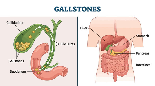 Human Gallstones Medical Diagram anatomical illustration showing gallbladder, bile ducts, and digestive system organs with labels ideal for healthcare education and medical blogs.