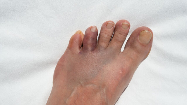 A bruised and swollen toe after hitting a rock. Foot injury concept, pain, injury, healthcare, and recovery.