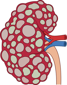 Polycystic kidney disease medical illustration