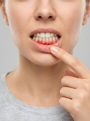 Fototapeta premium Woman Pointing At Red Swollen Bleeding Gums Showing Gingivitis Dental Problem Close Up