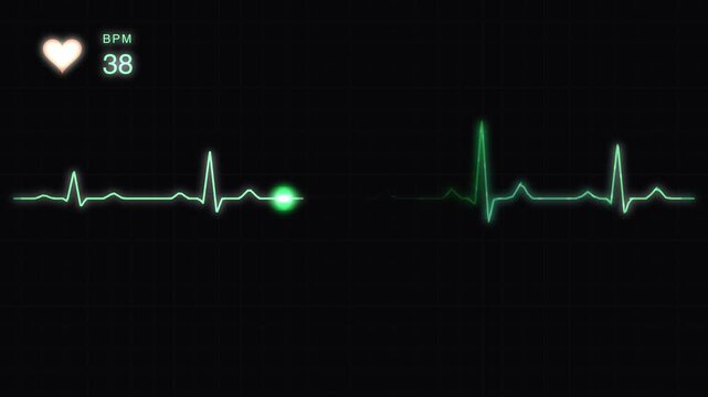 Medical heart rate monitor ekg display showing cardiac arrest and flatline pulse
