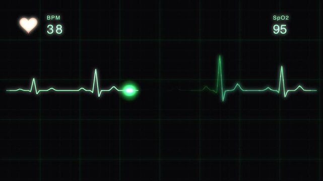 Medical heart rate monitor ekg display: flatline to normal sinus rhythm animation