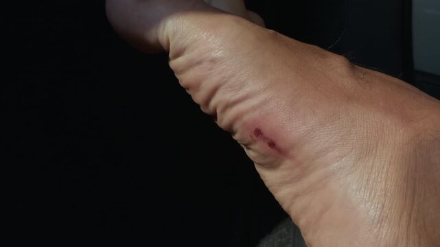 Close up of human foot with small healing wound near ankle against dark background