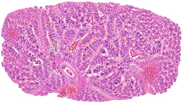 Hepatocellular Carcinoma Histopathology H&E Microscope Slide Human Liver Cancer