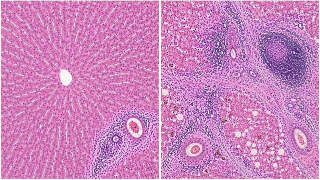 Healthy Liver vs Chronic Hepatitis C Histopathology H&E Microscopy Comparison Ultra Realistic