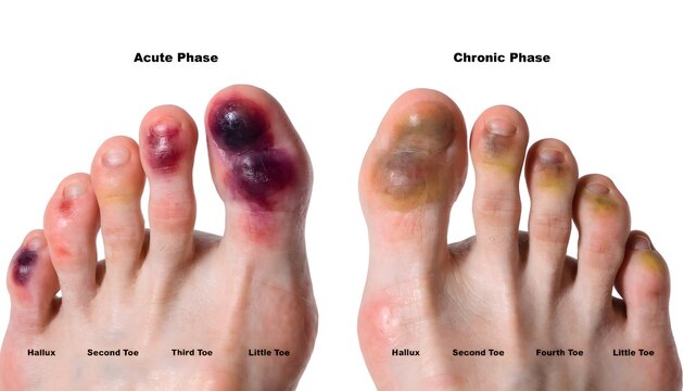 Multiple bruised toes from trauma impact with stage comparison, isolated frontal foot view