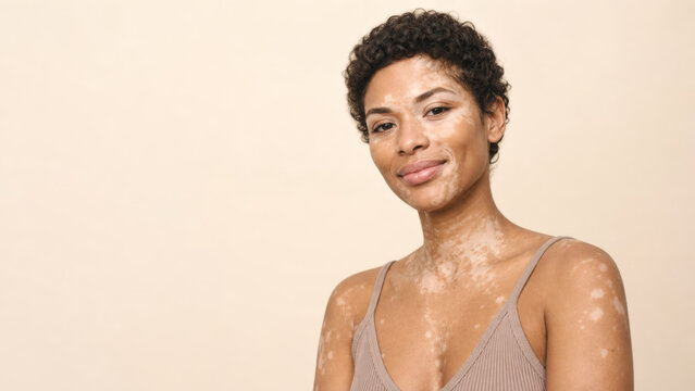 Confident woman with vitiligo skin condition smiling gently wearing beige tank top against neutral background