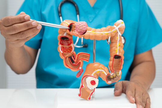Colorectal cancer, doctor holding intestine colon human anatomy model.