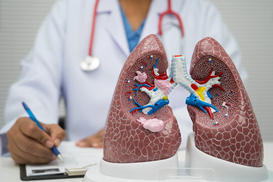 Pneumonia, lung cancer, Asian doctor with human lung model.