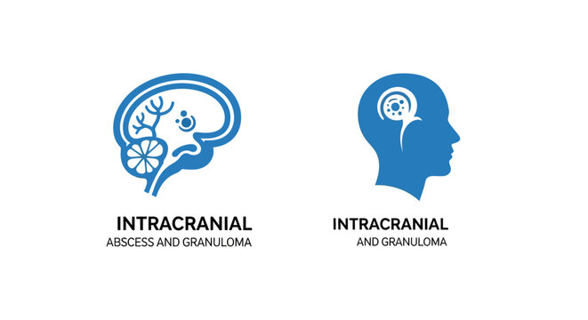 Illustration of intracranial hemorrhage in brain anatomy.