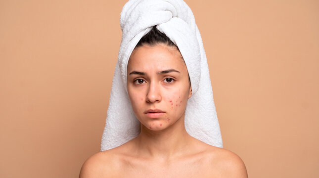 Young woman with acne and towel on head, concerned expression, studio portrait