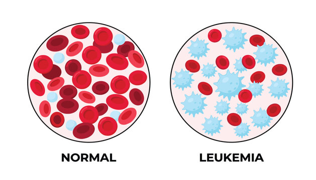 PrintMedical vector illustration comparing healthy normal blood cells with elevated white blood cell counts in leukemia.