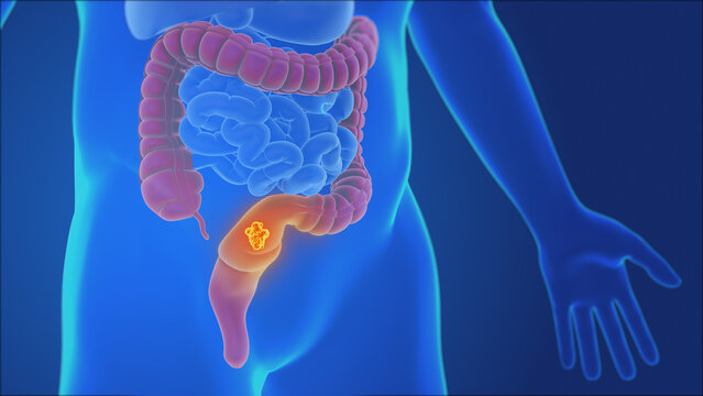 Human Colon and Rectal Cancer Visualization