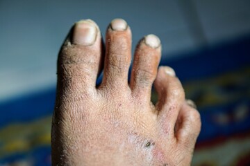 Fototapeta premium Medical condition on a patient's toes displaying signs of fungal infection, dermatitis, and hyperpigmentation.