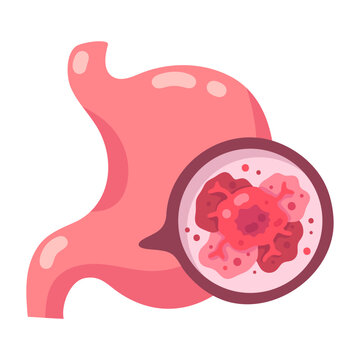 Medical illustration showing the human stomach affected by an internal disease or tumor growth