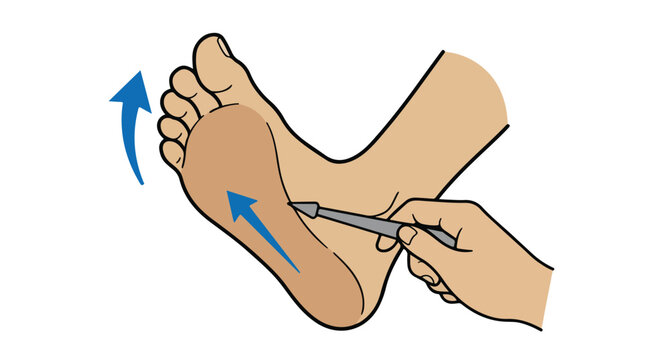 Babinski reflex medical illustration, plantar response neurological exam vector, diagnostic testing of human foot and toes for nerve damage