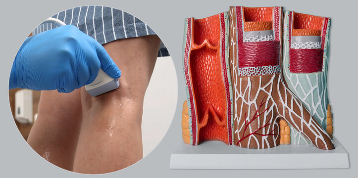 Doctor conducting leg veins ultrasound scan next to anatomical vascular blood vessels model. Phlebology diagnostic consultation.